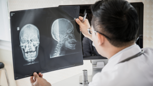 CT Brain Injury (TBI) Cases