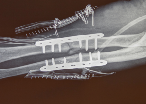 Hit in a Parking Lot by an Elderly Driver